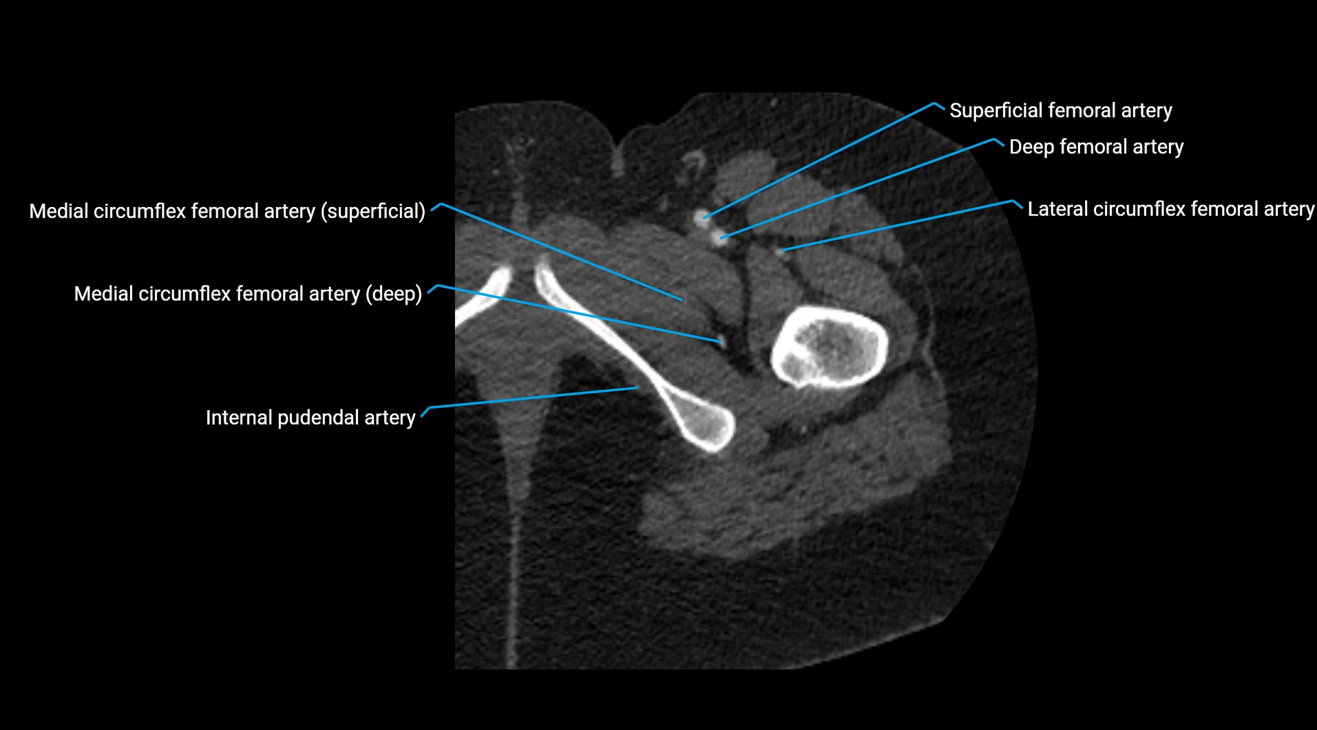 CTA lower limb cross sectional anatomy labelled image _71.webp
